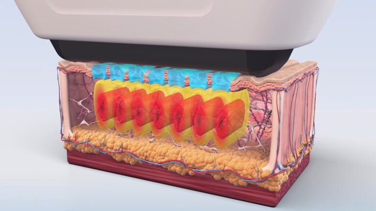 리프팅 레이저 완벽 비교 가이드: 소프웨이브 vs 울쎄라 vs 써마지