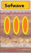 소프웨이브 작용 원리